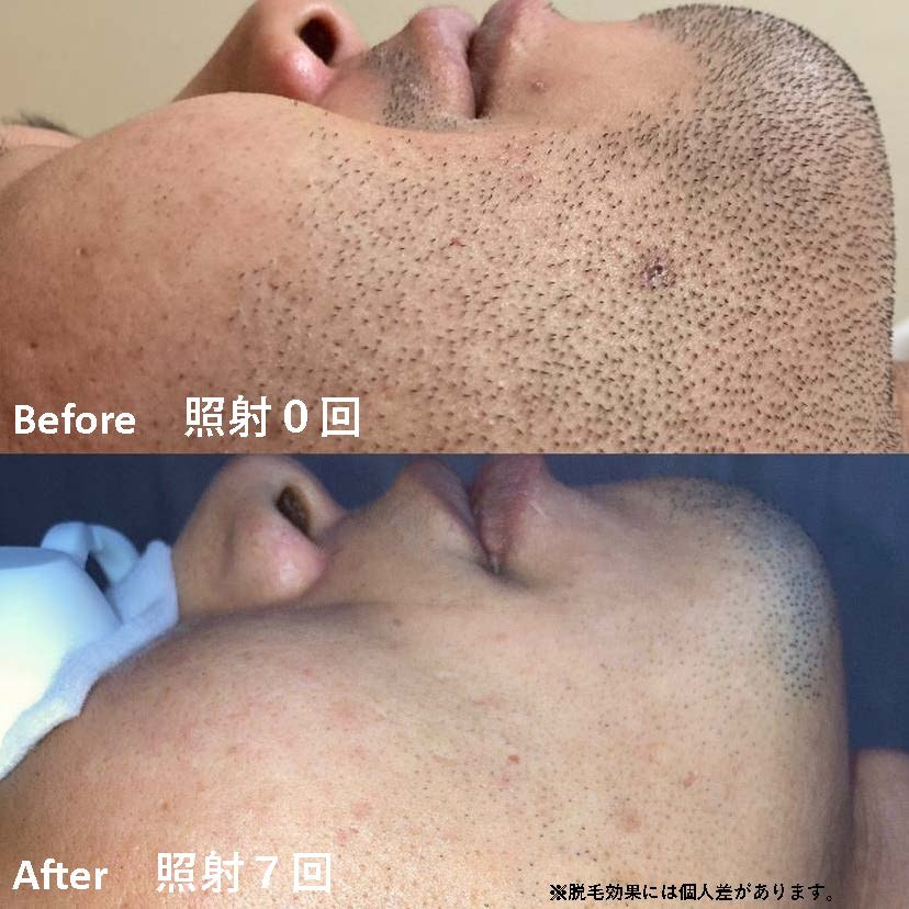 ヒゲ脱毛の照射0回と7回の比較（横顔）