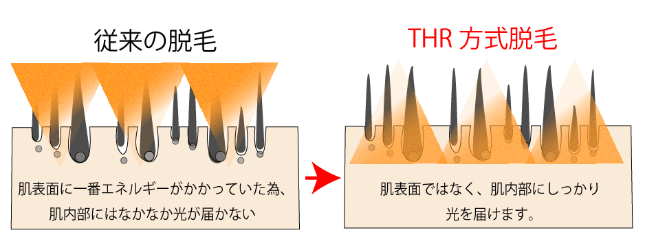 従来の脱毛とTHR方式脱毛の光の届き方の比較図
